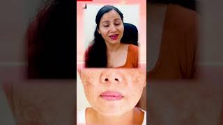 3 Rules In Ayurveda For Pigmentation  Best Natural Treatment Of Pigmentation At Home  Pigmentation [upl. by Kilah]