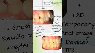 Correction of dental flaring or protrusion and a Class II bite with TADs amp braces braces sanramon [upl. by Sholley]