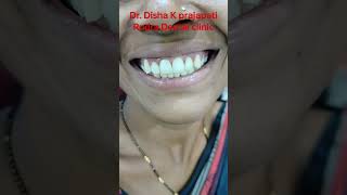 Teeth Cappingshorts trending ytshorts viral dental teeth dr youtubeshorts [upl. by Bran]