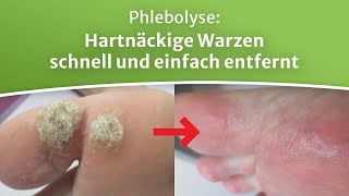 Warze entfernen ohne Betäubung und ohne Narbenbildung  Patientenbeispiele der Phlebolyse [upl. by Teloiv]