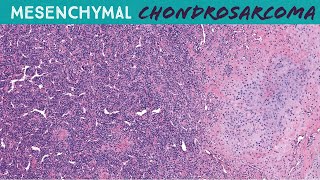 Mesenchymal Chondrosarcoma  round blue cell sarcoma with cartilage amp staghorn vessels UNC case 6 [upl. by Yttisahc269]