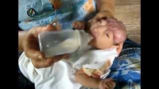 DVB TV News  A baby without skull born alive [upl. by Barbee253]