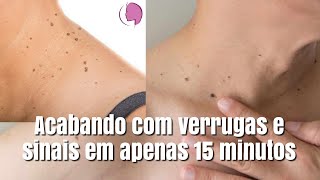 COMO ACABAR COM VERRUGAS E SINAIS EM APENAS 15 MINUTOS [upl. by Maddis]