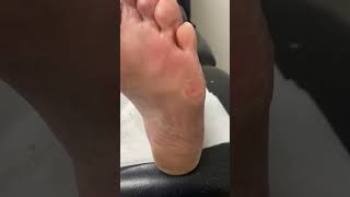 Quick amp Effective Corn and Callus Removal by Australian Podiatrist  Docpods [upl. by Leanor]