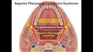 SuperiorPharyngealConstrictorSyndromeflv [upl. by Dunstan]