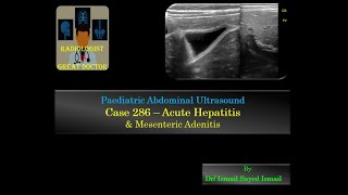 Ultrasound Case 286  Acute Hepatitis and Mesenteric Adenitis [upl. by Jeniece97]