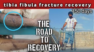 tibia fibula fracture recovery my journey150 days The Road To recovery [upl. by Burt]