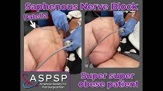 Saphenous Nerve Block in an Obese Patient [upl. by Tenrag]