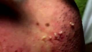 Acne Solution  Blackheads amp Whiteheads Removal 1  How to get rid of acne [upl. by Leontyne987]