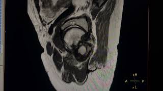 Subacute Osteomyelitis MRI Hip Joint 52YF [upl. by Toomin]