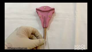 Copper T 380 A insertion and removal  Cu T n IUCD Insertion IUD Interval copperT OSCE USMLE [upl. by Netsrak]