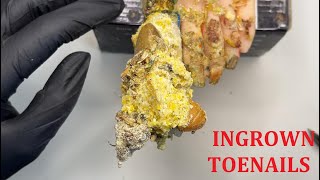 INGROWN TOENAILS toenail fungus corner of toe treatment A280 [upl. by Nelleyram]