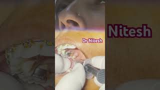 Inferior alveolar nerve block [upl. by Ollayos855]