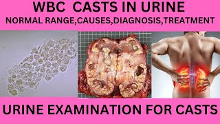 WBC CAST IN THE URINE CAUSES SYMPTOMS AND TREATMENT OF WBC CAST IN URINE EXAMINATIONURINE ROUTINE [upl. by Weiss]