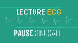 Interprétation ECG  Pause Sinusale [upl. by Merri]