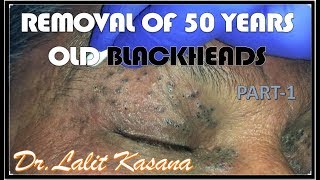 HOW TO REMOVE BLACKHEADS BY COTTON BUDS TECHNIQUE by DRLALIT KASANA [upl. by Odicalp115]