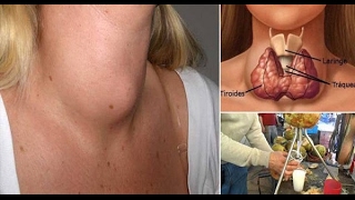 Doctors Will Never Tell You This Cure Your Thyroid Gland with Just One Ingredient [upl. by Lamoree]