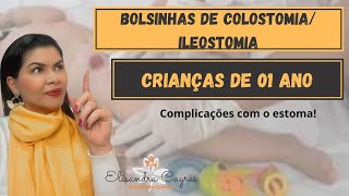 COLOSTOMIAILEOSTOMIA EM CRIANÇAS DE 01 ANO E SUAS COMPLICAÇÕES  ESTOMATERAPIA [upl. by Radek717]