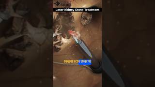 Kidney stone removal  Kidney stone treatment  laser treatment  Rirs  shorts curestone [upl. by Kerr669]