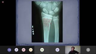 TRAUMATOLOGÍA Y ORTOPEDIA  Aula 1  GENERALIDADES Y FISIOPATOLOGIA OSEA [upl. by Acined]