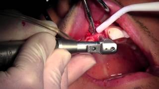 CAMLOG Implant Placement 8 into Mineross Regenerated Bone Initial Pilot Hole [upl. by Sudnac]