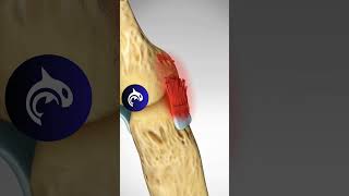 See what Skiers Thumb looks like in 3D Animation [upl. by Onej]