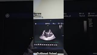 Mitral Valve Prolapse by echocardiogram 😱😢 echocardiogram echocardiography heart [upl. by Anoek]