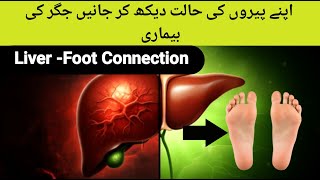 How to Use Your Feet to Diagnose Liver Problems In UrduHindi [upl. by Casaleggio415]