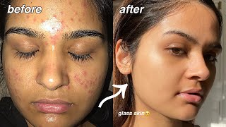 how i cleared my acne FOR GOOD something finally worked [upl. by Diarmit]