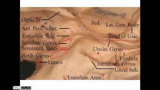 Neurosurgery Temporal lobe anatomy and its implications in temporal lobe epilepsy [upl. by Darra163]