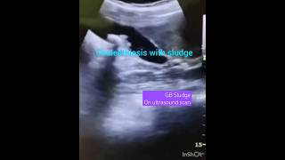 Ultrasound short clipsgall bladder scangall bladder sludgegb sludgecholelithiasisytshorts [upl. by Sharline]