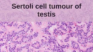 Sertoli Cell Tumour of the Testis  Pathology mini tutorial [upl. by Jehias803]