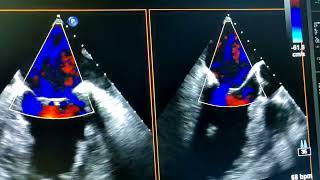 Valoración de valvulopatías mediante ecocardiograma transesofágico [upl. by Annalee761]