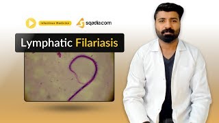 Lymphatic Filariasis  Medicine Lectures  Medical Student  VLearning  sqadiacom [upl. by Ausoj]