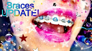 Braces UPDATE Retainers springs midline 😬 [upl. by Iccir]