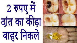 सिर्फ एक बार इस्तेमाल से दांत का कीड़ा बाहर निकालें  How To Get Rid Of Tooth Cavity 100 Effective [upl. by Rainger551]