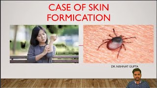 CASE OF SKIN FORMICATION by Dr NISHANT GUPTA [upl. by Cresa]