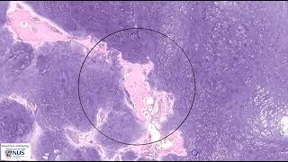 Chondrosarcoma Microscopy  Talking slide [upl. by Ycnaf172]