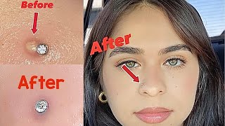 How to get rid of a nose piercing bump fast Keloid [upl. by Solracsiul]