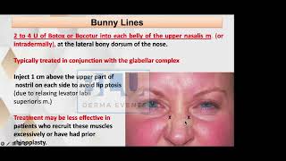 BOTOX Part 6 Bunny lines Nasalis Muscle [upl. by Hadsall740]