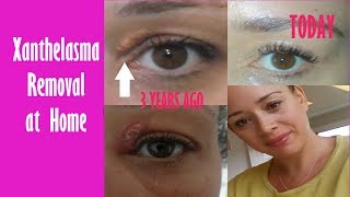 Xanthelasma Removal at Home  How I Removed Mine 3 Years Ago  Fatty Eye Cholesterol Deposit [upl. by Sweatt]