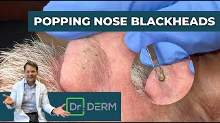 Popping Nose Blackheads  Dr Derm [upl. by Ardnoik302]