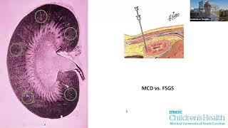 Pediatric FSGS and the Utility of Lipopheresis CME Recording [upl. by Garap]