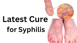 Latest treatment of syphilis How to cure any stage of syphilis [upl. by Eynenihc621]