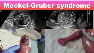 Meckel Gruber syndrome I Ultrasound [upl. by Fidel]