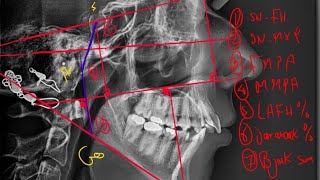 08 b Skeletal Vertical Assessment Cephalometric analysis [upl. by Adore133]