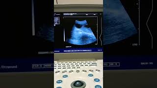 Anencephaly Fetus skull Absence 😨😨😕😕pregnancyscan shortvideo foryou [upl. by Callan483]