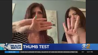 Simple ThumbPalm Test May Help Detect Likelihood Of Aneurysm [upl. by Naida]