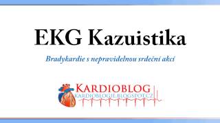 Kardioblog  EKG Kazuistika Bradykardie s nepravidelnou srdeční akcí [upl. by Eeleak]