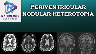 Periventricular nodular heterotopia [upl. by Salb]